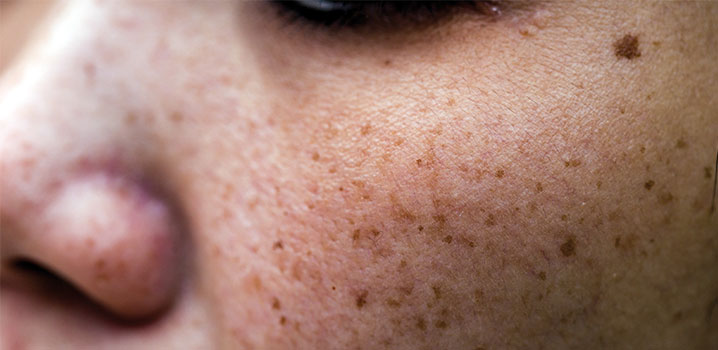 Äußerliche Merkmale von Lichtalterung