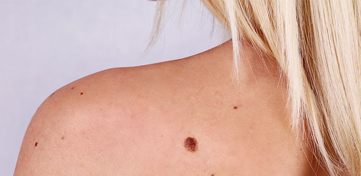 Risikofaktoren für schwarzen Hautkrebs